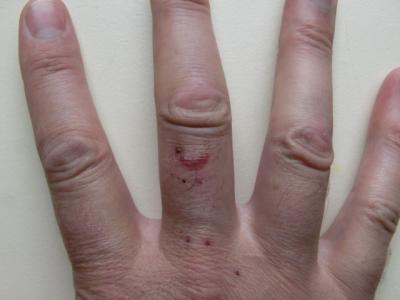 bloedblaarhand